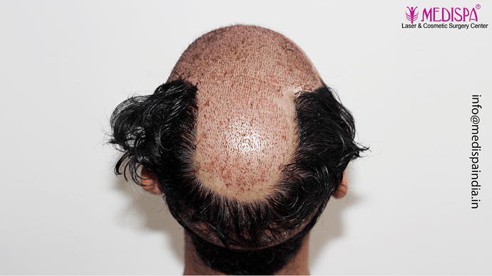 Dr. Suneet Soni - 4046 Grafts | 12-Month Result | Combination FUT + FUE + Beard photo