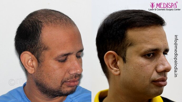 Dr. Suneet Soni - 4500 Grafts, Combine FUT + FUE Technique, NW-III photo