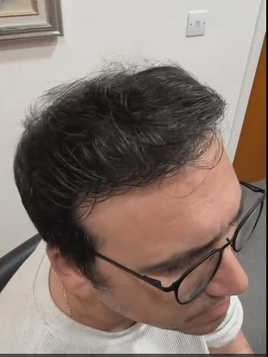 HDC Hair Clinic – FUE Hair Transplant Result for 4534 Grafts photo