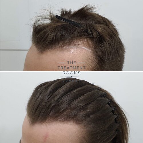 Small temple hair transplant- 600 grafts photo