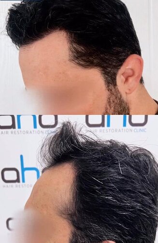 DR HAKAN DOGANAY/ 2000 GRAFTS / Implanter Pen+FUE photo