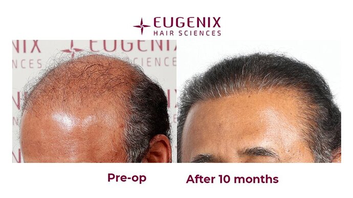 Eugenix Hair Sciences| NW 7 | 6309 Grafts | 10 Months Post-op| Dr. Pradeep Sethi photo