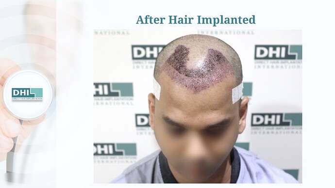 DHI India™ | NW 5 | 3,257 Grafts | 7 Months Hair Transplant Result photo