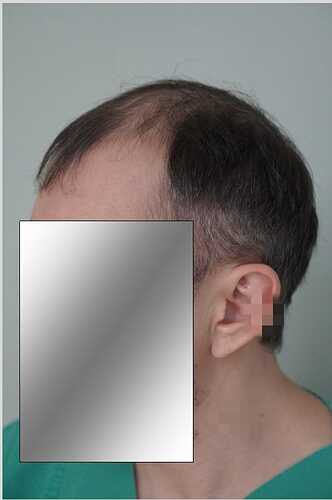 Hattingen Hair Clinic, 4 435: 4 093 FUT and 342 FUE. photo