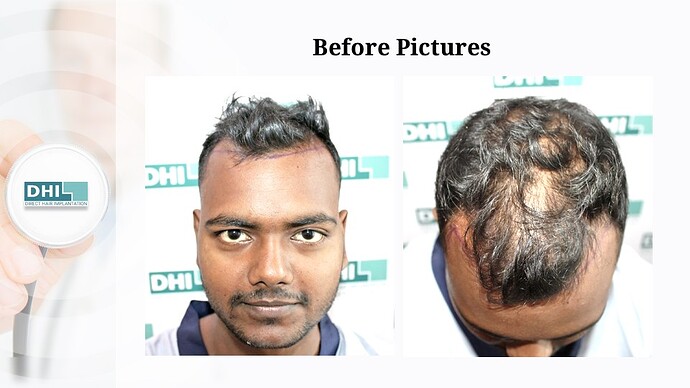 DHI India | NW 4 | 2,354 Grafts | 7-Months DHI Hair Transplant Results photo