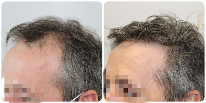 Dr Bonaros, Glasgow, UK / 3595 FUE grafts / 0-12 Months photo