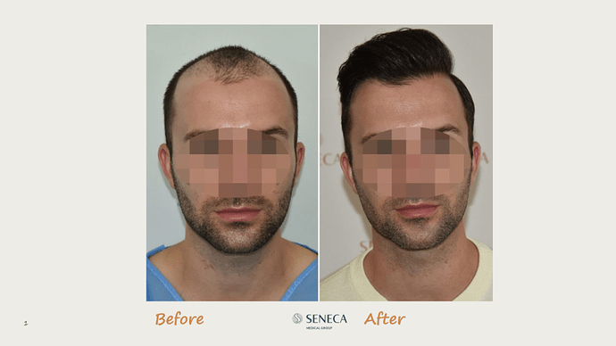 Seneca Medical Group - 2660 grafts with Direct Fue photo