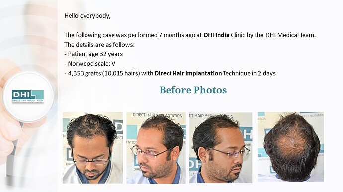 DHI India | NW Scale 5 | 4,353 Grafts | 07 Months DHI Hair Transplant Result photo