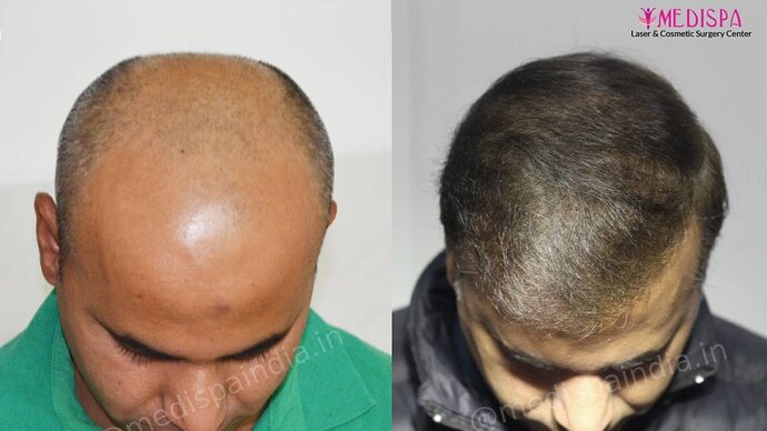 11600 Grafts in 3 FUT Sittings by Dr Suneet Soni photo