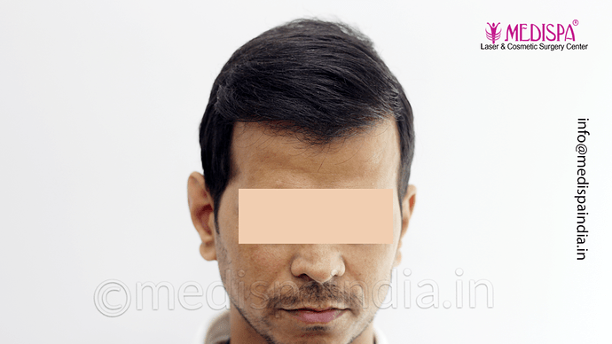 Dr. Suneet Soni - 4533 Grafts, Combine FUT + FUE Technique , NW-IV/V photo