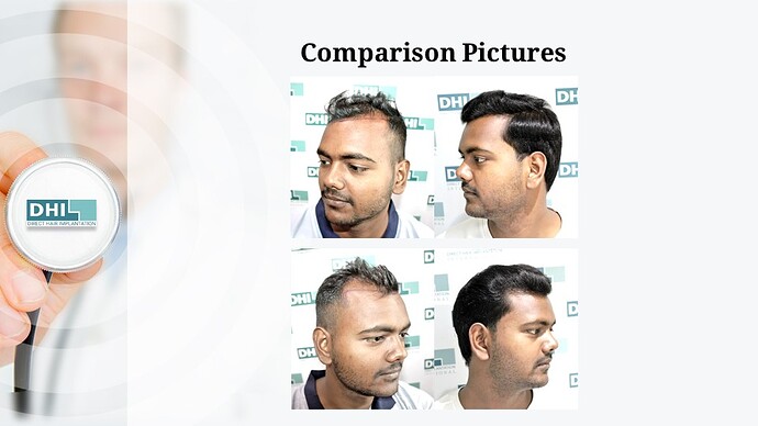 DHI India | NW 4 | 2,354 Grafts | 7-Months DHI Hair Transplant Results photo
