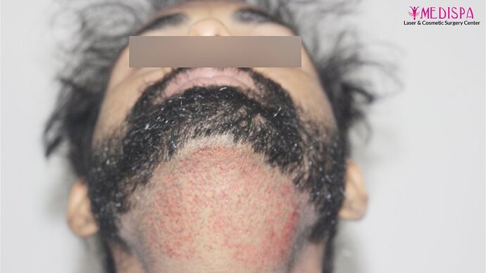 Revision Hair Transplant - 5111 Grafts / 5 Years Result - Dr. Suneet Soni, Medispa India photo