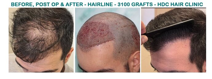 FUE Hair Transplant Result for 3100 Grafts - NW3 – 8 Months After – HDC Hair Clinic photo