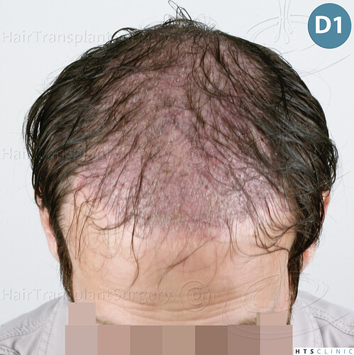 Dr. Jean Devroye, HTS Clinic / 4510 Combo (3510 FUT + 1000 FUE) Repair / 1 session photo