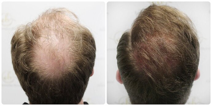Dr Bonaros, Glasgow, UK / 4081 FUE grafts / 0-12 Months photo