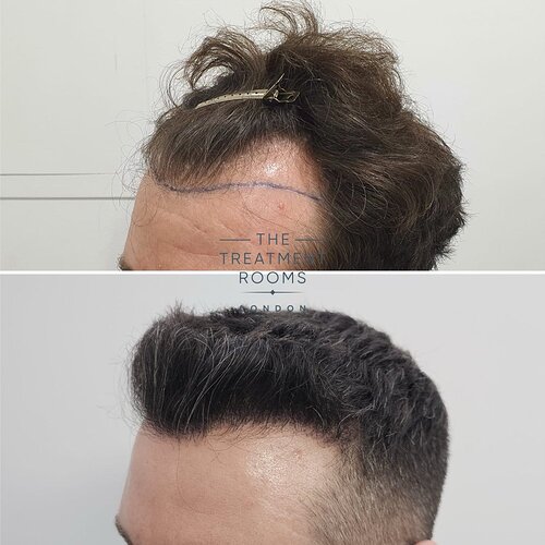 Hairline Transplant- 1745 Grafts- 14 Months Post Surgery photo