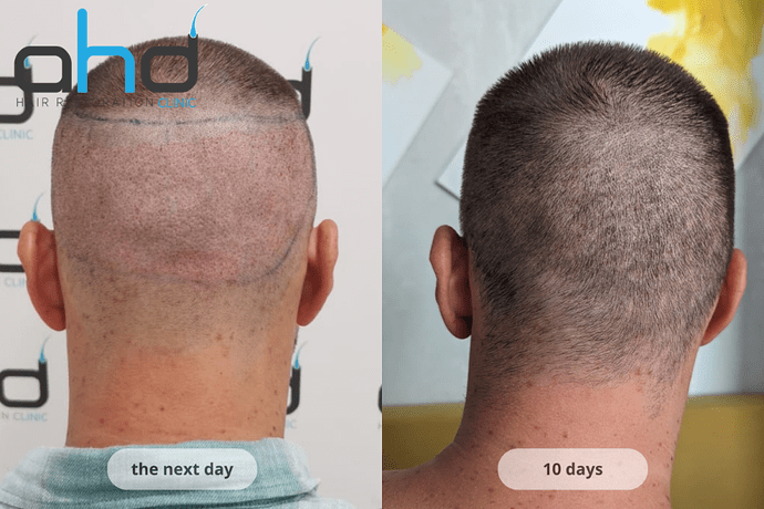 AHD Clinic / Technicians / 2250 grafts / FUE + DHI photo
