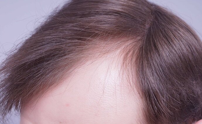 Dr B Farjo 1560g FUE (Frontal) photo