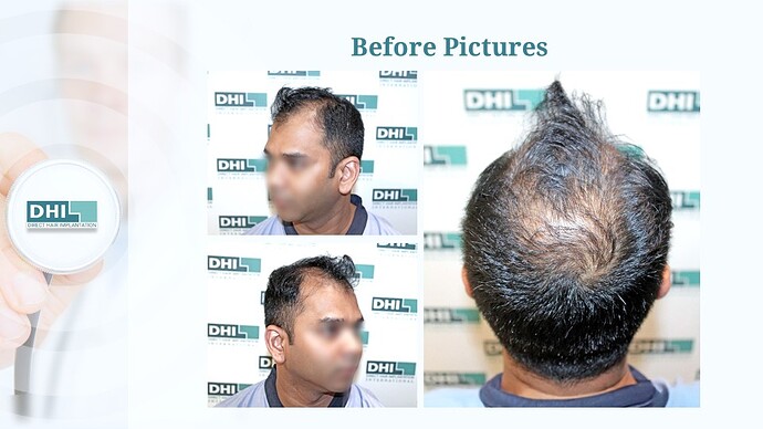 DHI India™ | NW 5 | 3,257 Grafts | 7 Months Hair Transplant Result photo