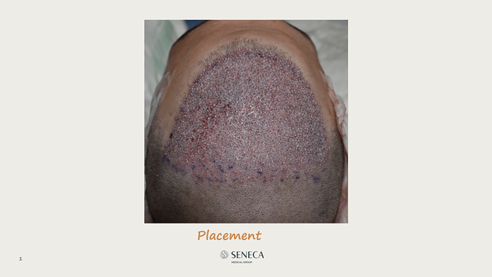 Seneca Medical Group - 2308 grafts with Direct Fue photo