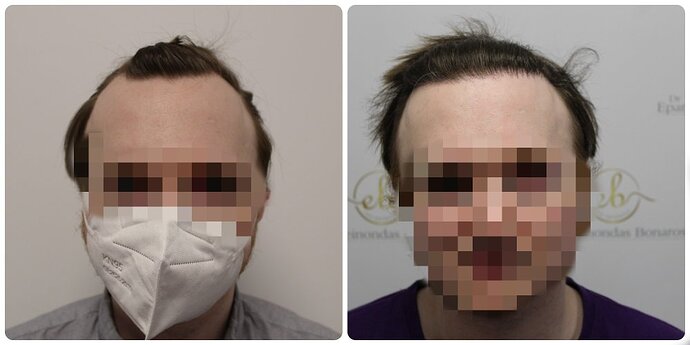 Dr Bonaros, Glasgow, UK / 1614 FUE grafts for receding Hairline / 0-12 Months photo