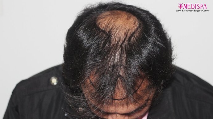 Dr. Suneet Soni - 4937 Grafts, Combine FUT + FUE Technique, NW : IV-V photo