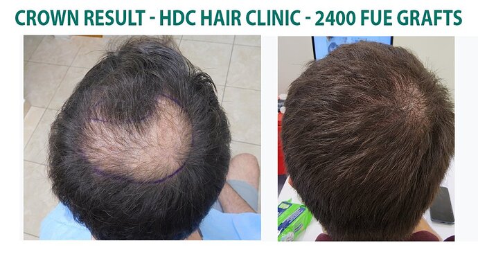 2400 Grafts Crown Result – 9 Months After – HDC Hair Clinic – Dr Maras photo
