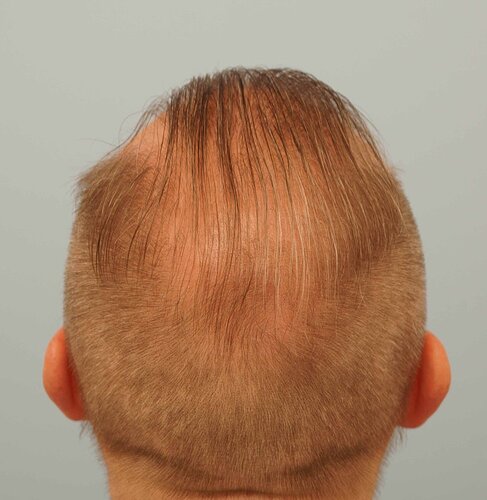 Dr B Farjo 1700g FUE (Front) photo