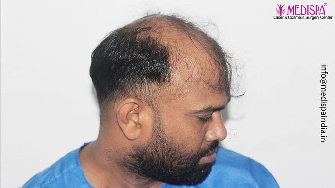 Dr. Suneet Soni - 5498 Grafts, 2 Years Result, Combine FUT + FUE + Beard Technique, NW-VI photo