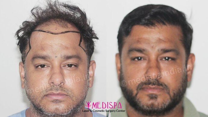 Dr. Suneet Soni - 5000 Grafts, Combine FUT + FUE + BHT (Beard) Technique, NW-V, 2.5 Year Result photo