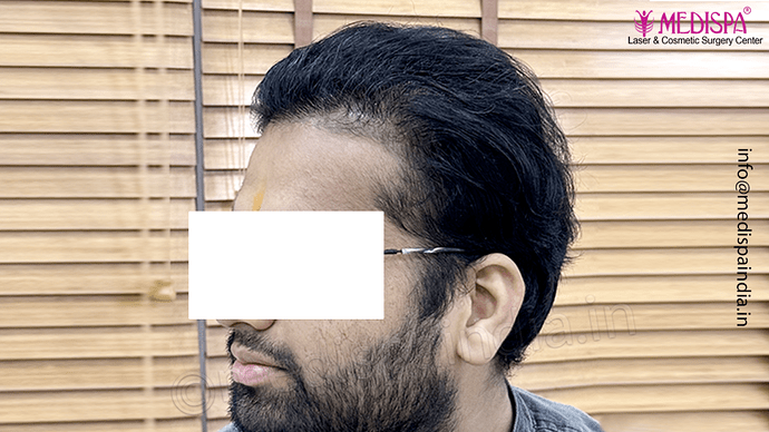 Dr. Suneet Soni - 5467 Grafts, Combine FUT + FUE + Beard Technique, NW- V, 3 Years Result photo