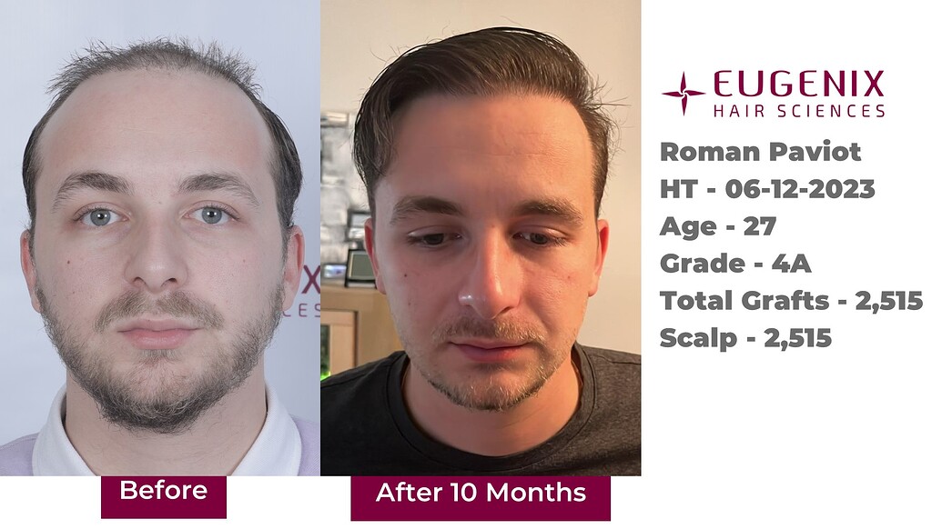 https://cdn.forumhairtransplant.com/optimized/3X/9/f/9f161f38152b77f131e1e5ee54f49ee49f3205f5_2_1035x582.jpeg