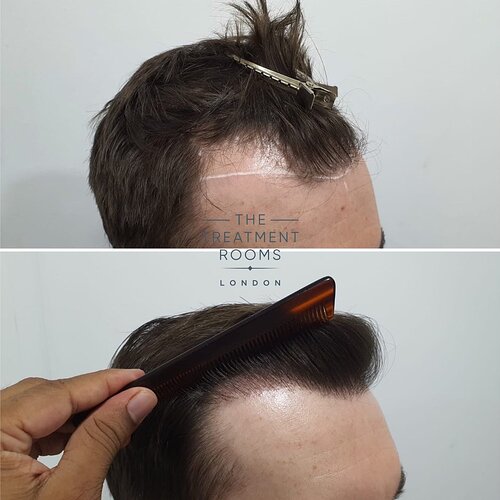 Small hairline 1014 grafts before and after photo