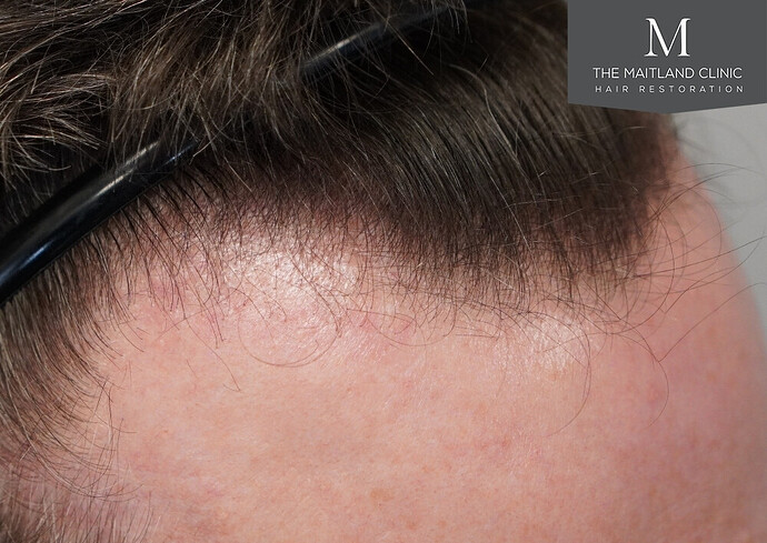 Before and after results: 1694 grafts by FUE at The Maitland Clinic (Dr Edward Maitland Ball) photo