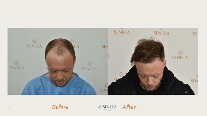 Seneca Medical Group - 3200 grafts with Direct Fue photo