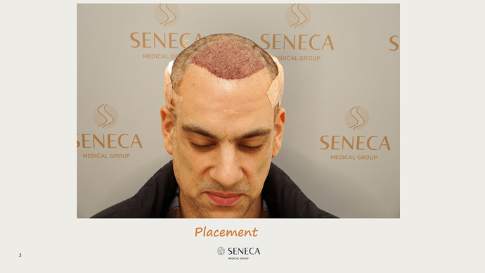 Seneca Medical Group - 2065 grafts with Direct Fue photo