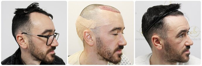 Dr Bonaros, Glasgow, UK / 1816 FUE grafts / 0-12 Months photo