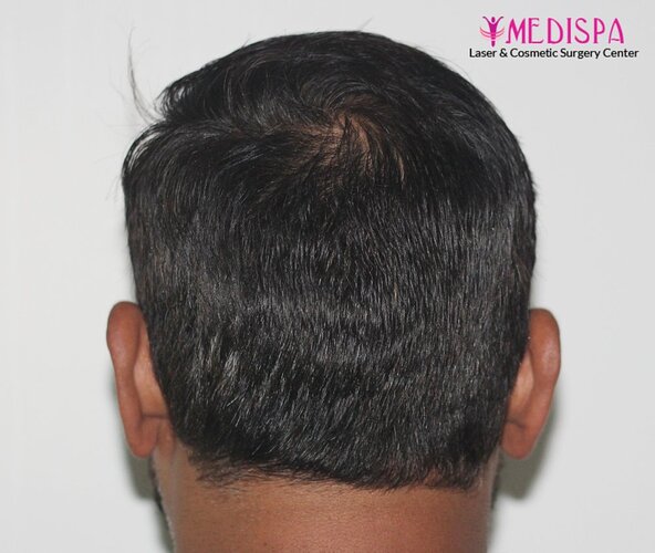 Dr. Suneet Soni - 5000 Grafts, Combine FUT + FUE + BHT (Beard) Technique, NW-V, 2.5 Year Result photo