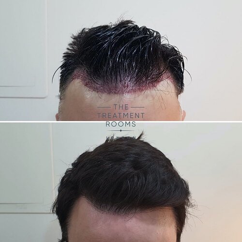 Hairline FUE hair transplant surgery photo