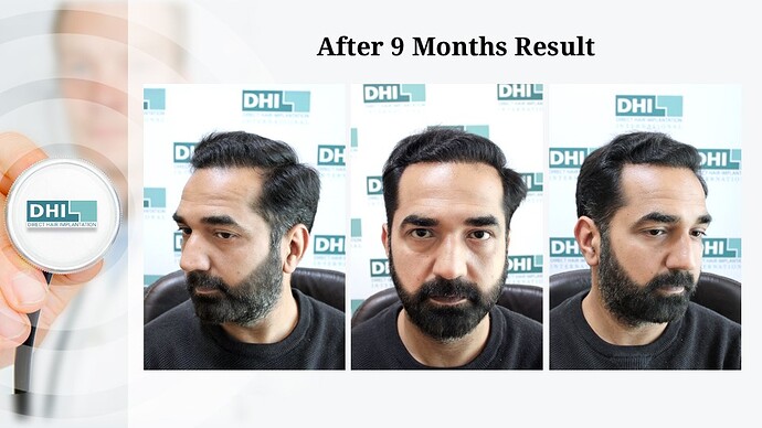 DHI India | NW 6 | 3,460 Grafts | 9-Months DHI Hair Transplant Results photo