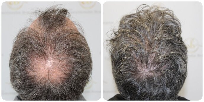 Dr Bonaros, Glasgow, UK / 3595 FUE grafts / 0-12 Months photo