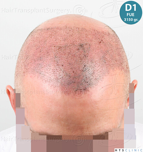 Dr. Jean Devroye, HTS Clinic / 6494 FUE-BHT (3150 + 3344) / NW VII, 2 sessions photo