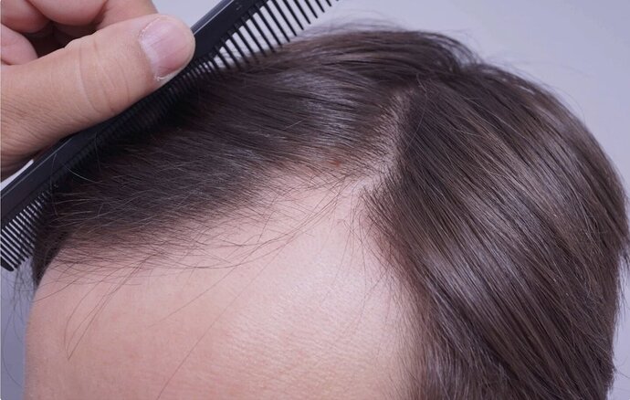 Dr Bessam Farjo FUE 1720 grafts to frontal recessions photo