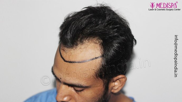 Dr. Suneet Soni - 3029 FUE Grafts, FUE Method (Trivellini System), NW - III photo