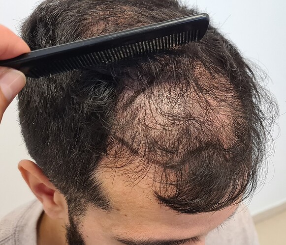 FUE Hair Transplant Result for 3100 Grafts - NW3 – 8 Months After – HDC Hair Clinic photo