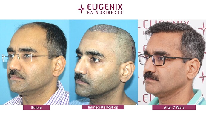 hair-transplant-before-after-11
