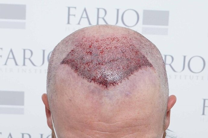 Dr B Farjo - FUE - 2091 Grafts photo