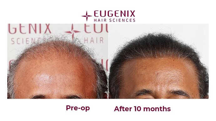 Eugenix Hair Sciences| NW 7 | 6309 Grafts | 10 Months Post-op| Dr. Pradeep Sethi photo