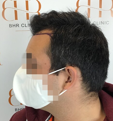 Dr. Bisanga BHR Clinic - 2350 FUE 0 – 12 Months with Photos and Video photo