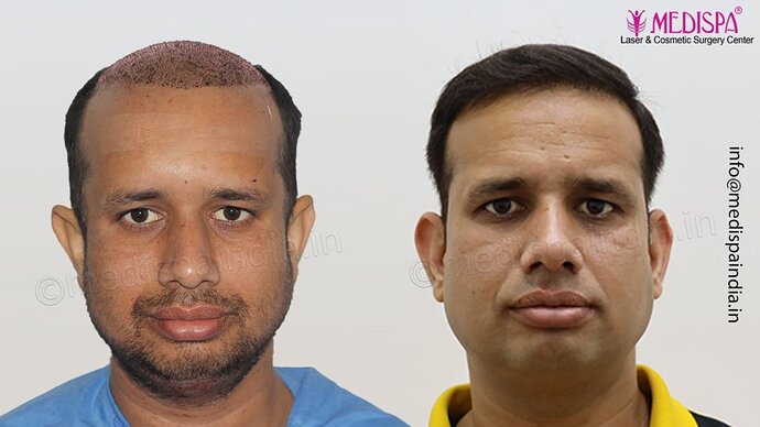 Dr. Suneet Soni - 4500 Grafts, Combine FUT + FUE Technique, NW-III photo